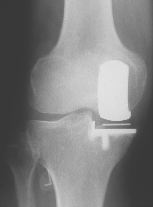 Knie_Oxford_X-ray