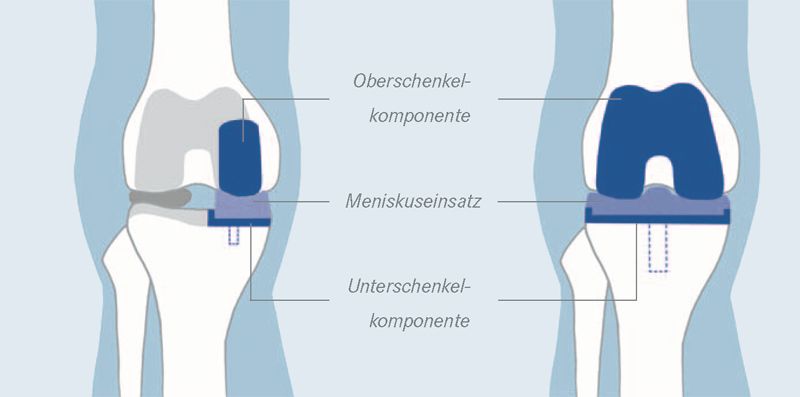 Knie_schema3