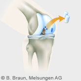 Kniegelenk_Knorpeltherapie_Autologe-Chon