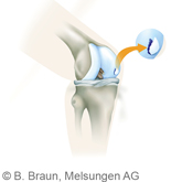 Kniegelenk_Knorpeltherapie_Defekt-bei-Os2