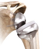 Schulter_Endoprothetik_Inverse-Delta-Sch