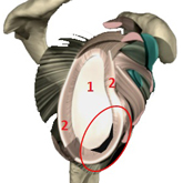 Schulter Instabilitaet Hill Sachs Delle