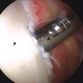 Schulter_Instabilitaet_arthroskopische-1