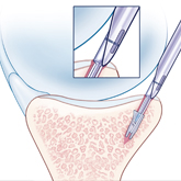 Schulter_Instabilitaet_arthroskopische-2