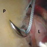 Schulter_Instabilitaet_arthroskopische-3