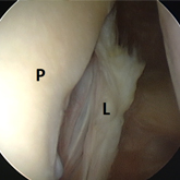 Schulter Instabilitaet arthroskopische O