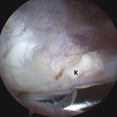 Schulter Kalkschulter Arthroskopisches B