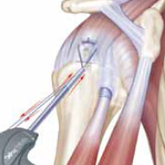 Schulter Rotatorenmanschettenlaesion